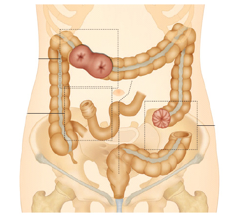 Pdf Vaginal Replacement In The Pediatric Age Group
